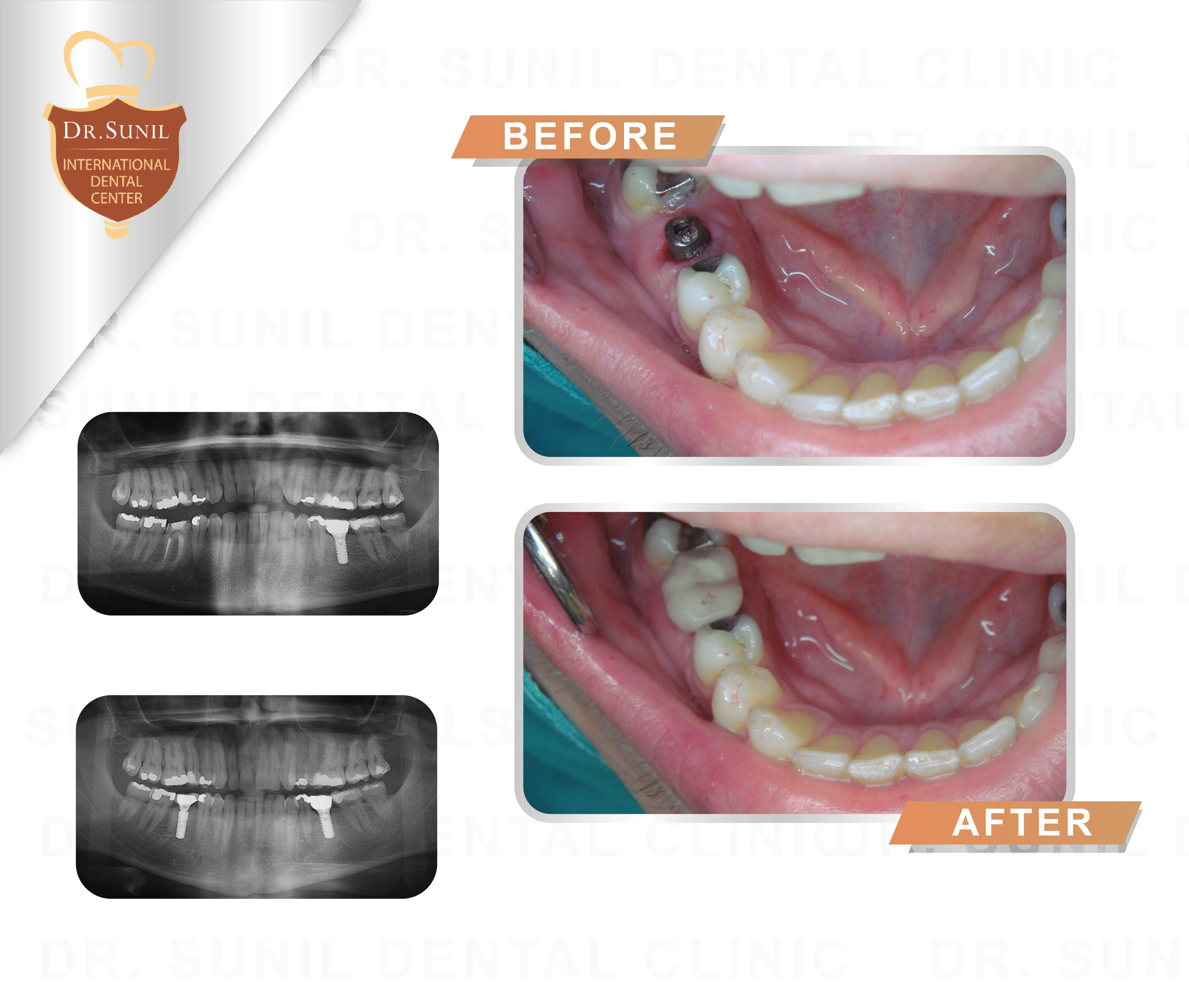 Thailand Dental Implant